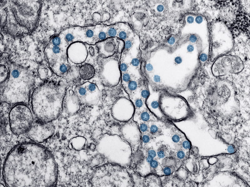 COVID-19显微镜图像。(Hannah A. Bullock, Azaibi Tamin/CDC)
