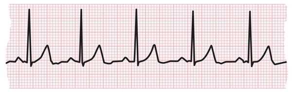 ECG条形显示正常心跳