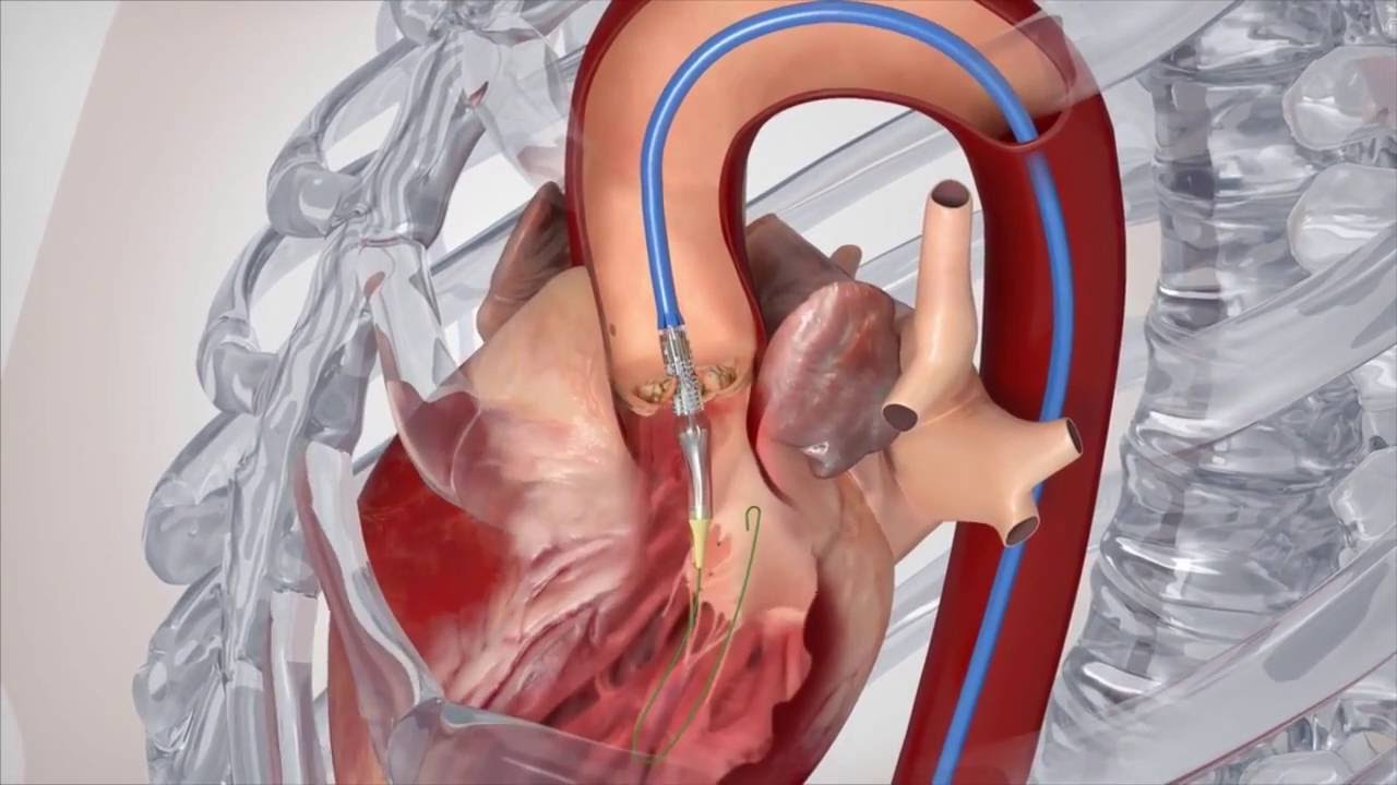 影响心脏瓣膜手术恢复的因素视频截图